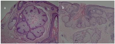 Detection of sebaceous gland hyperplasia with dermoscopy and reflectance confocal microscopy